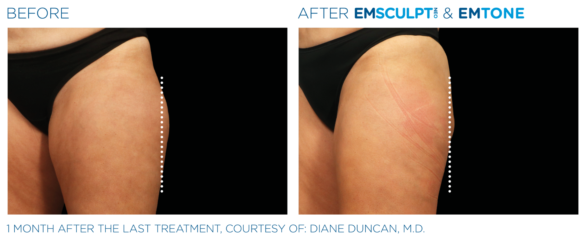 Advertorial: Treating the Inner Thighs with EMSCULPT NEO